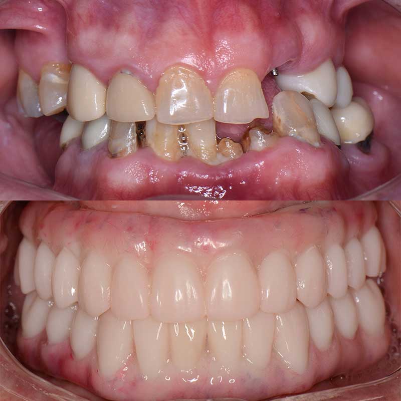 bio-dental-care-tijuana-before-and-after-smile-makeover-1
