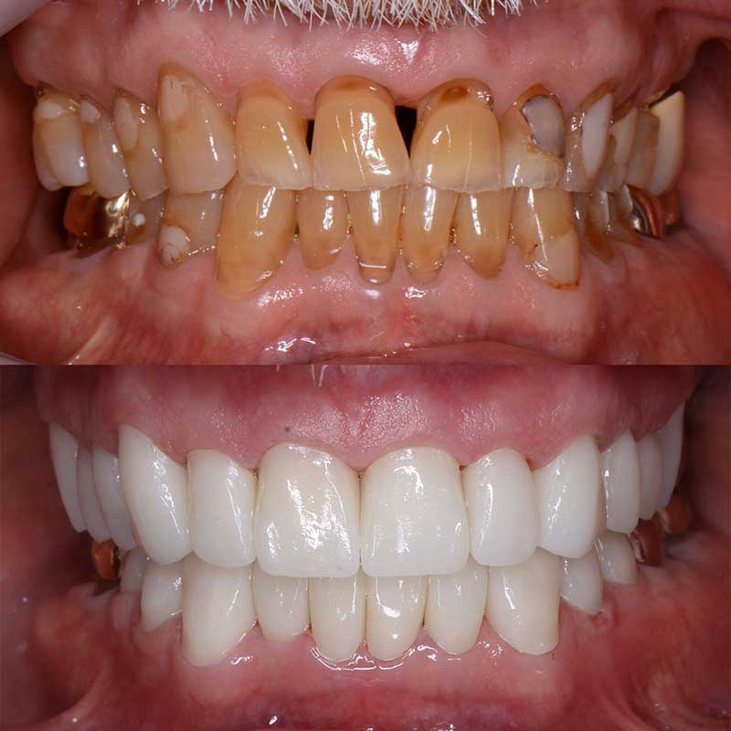 bio-dental-care-tijuana-before-and-after-smile-makeover-2
