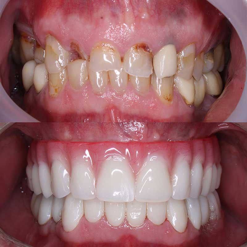 bio-dental-care-tijuana-before-and-after-smile-makeover-3