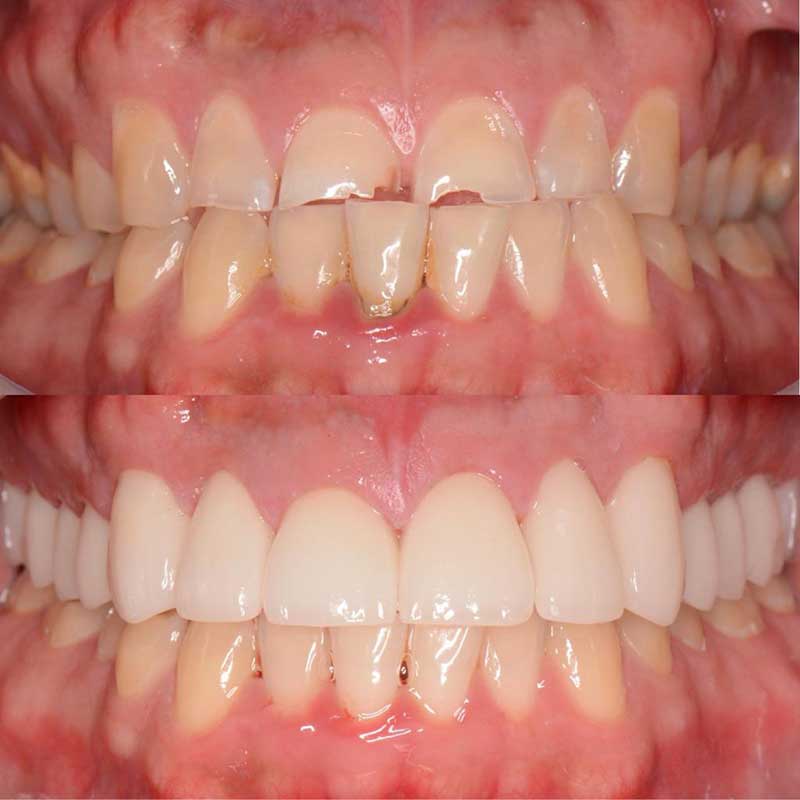 bio-dental-care-tijuana-before-and-after-smile-makeover-4