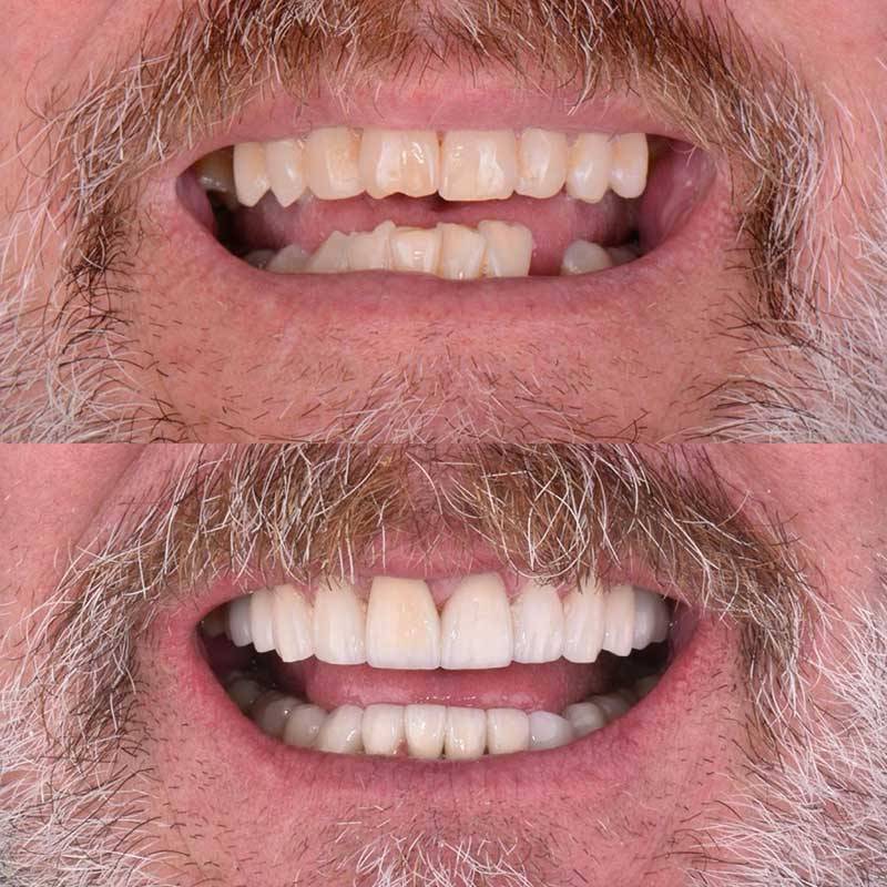 bio-dental-care-tijuana-before-and-after-smile-makeover-5