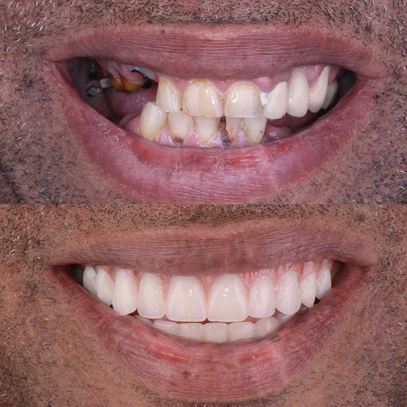bio-dental-care-tijuana-before-and-after-smile-makeover-7